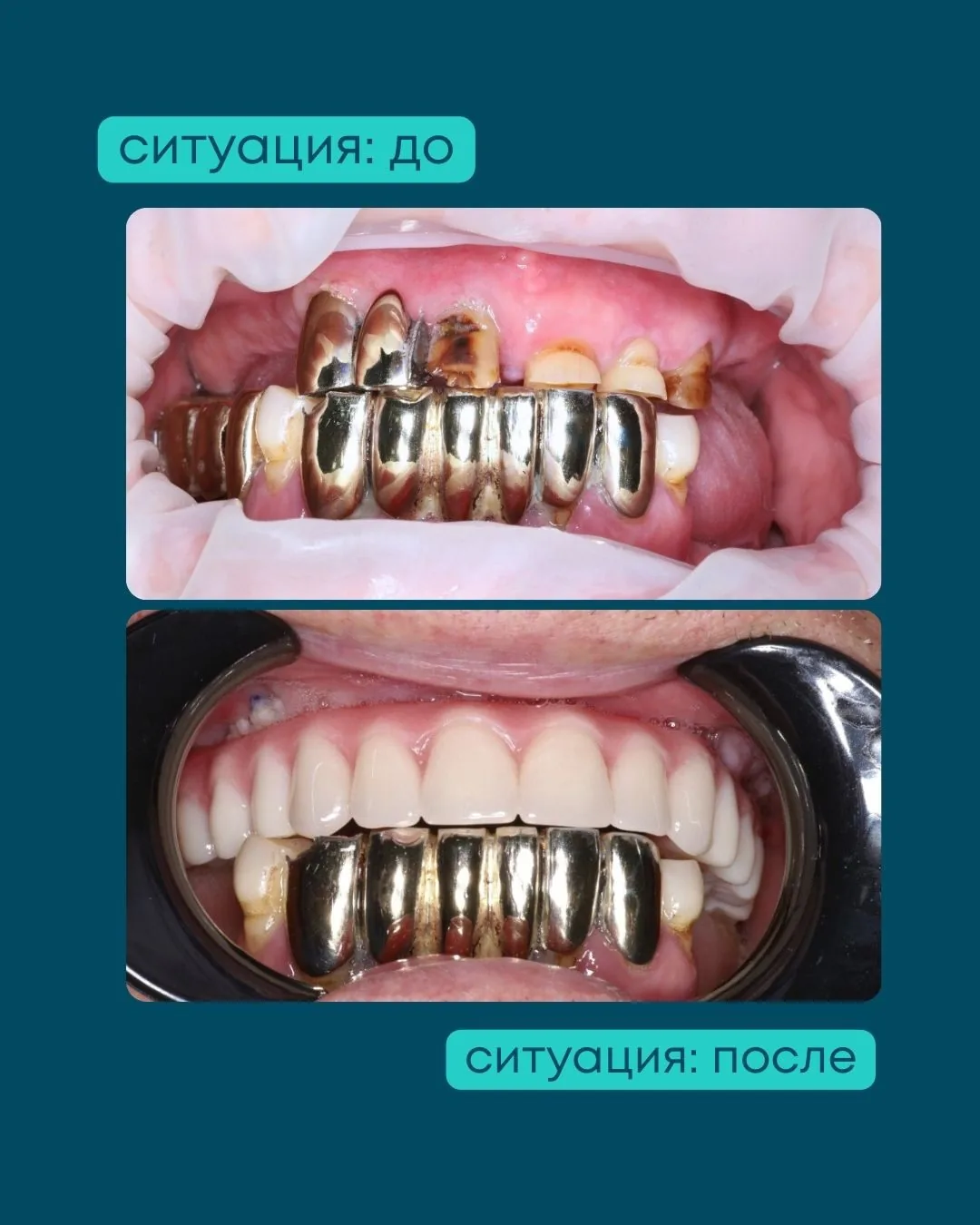 All-on-4 на верхней челюсти после несостоятельных мостов в Астане