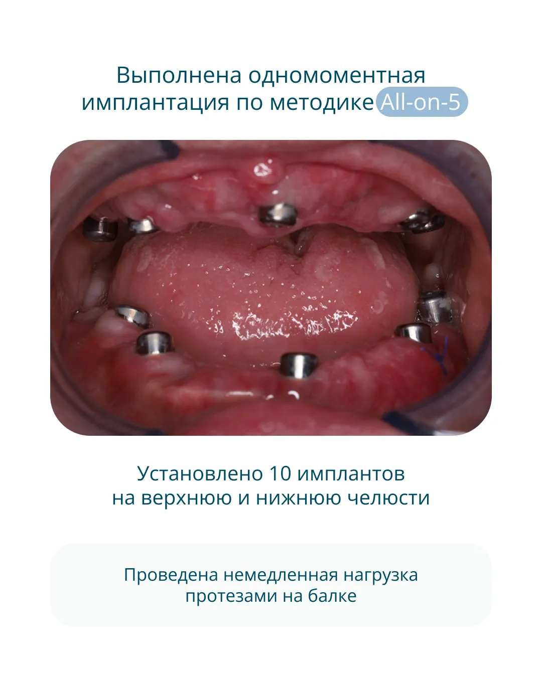 Полная реабилитация на имплантах по методике All-on-5 в Астане: Стадия 2