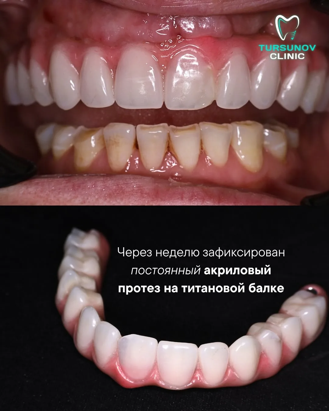 All-on-5: постоянный протез на титановой балке через неделю в Астане