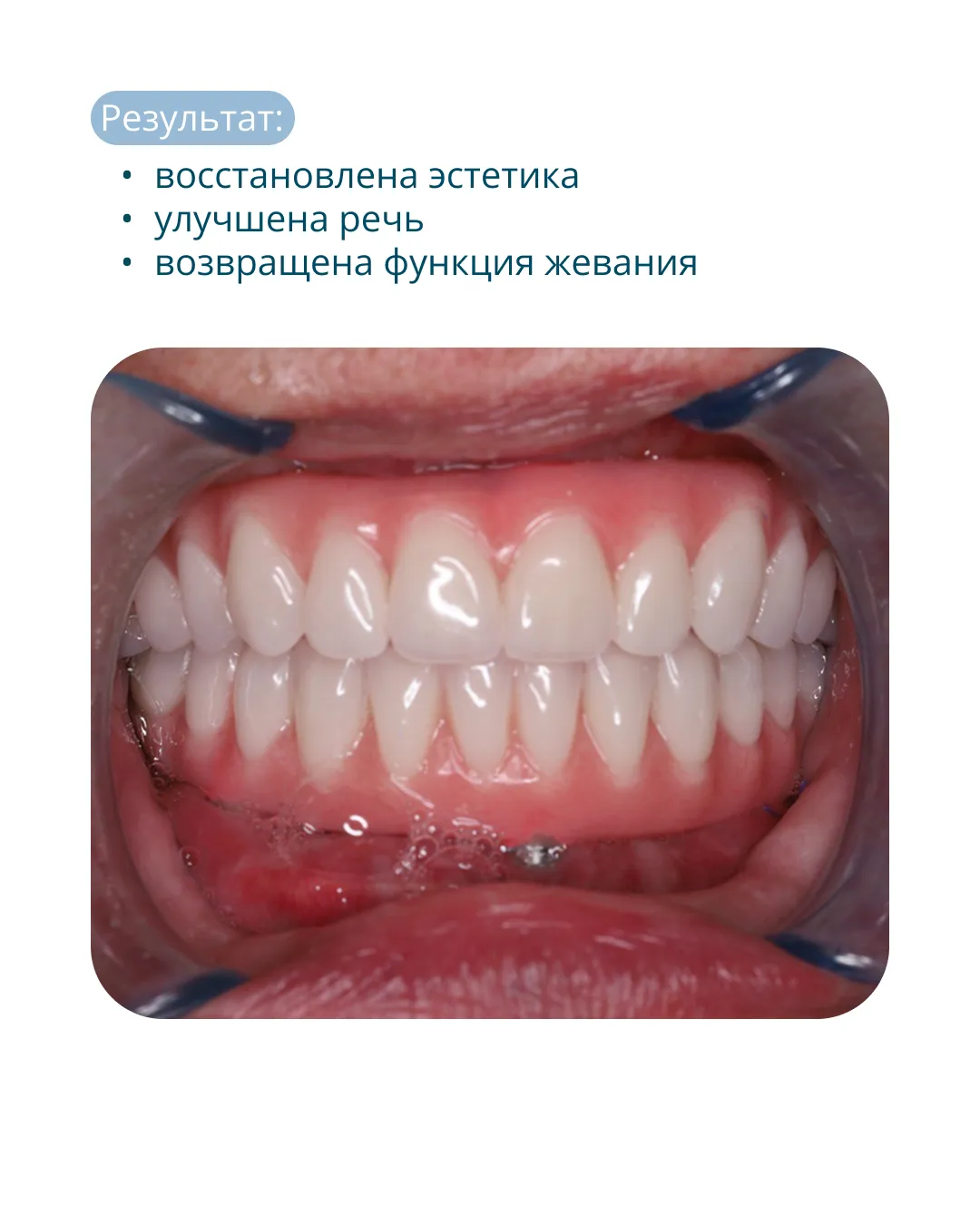 Полная реабилитация на имплантах по методике All-on-5 в Астане: Результат