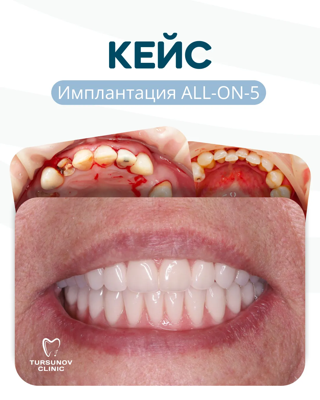 Полная реабилитация на имплантах по методике All-on-5 в Астане