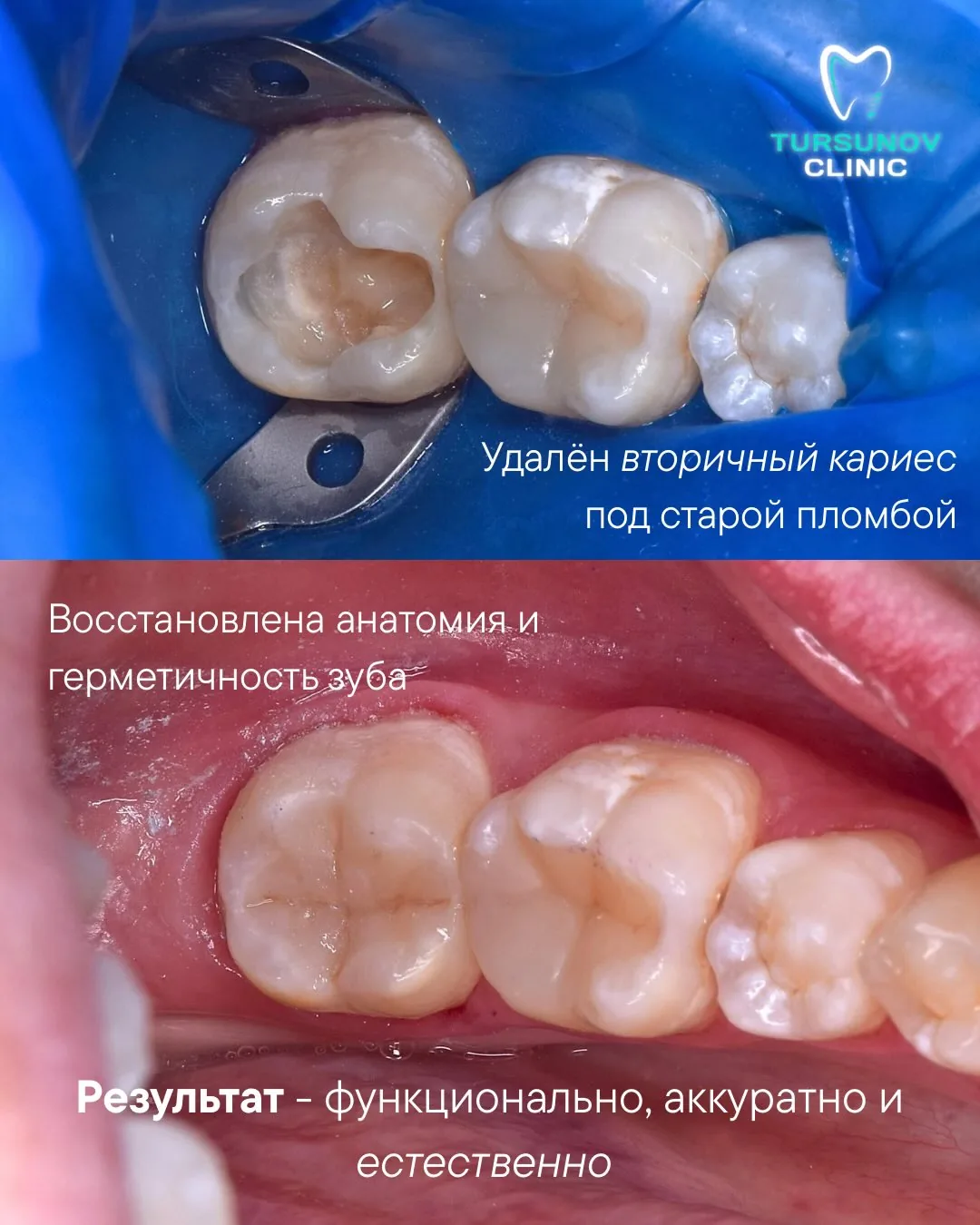 Вторичный кариес жевательного зуба: лечение и реставрация